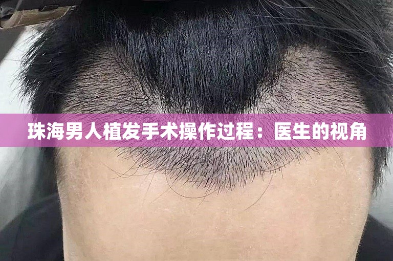 珠海男人植发手术操作过程：医生的视角