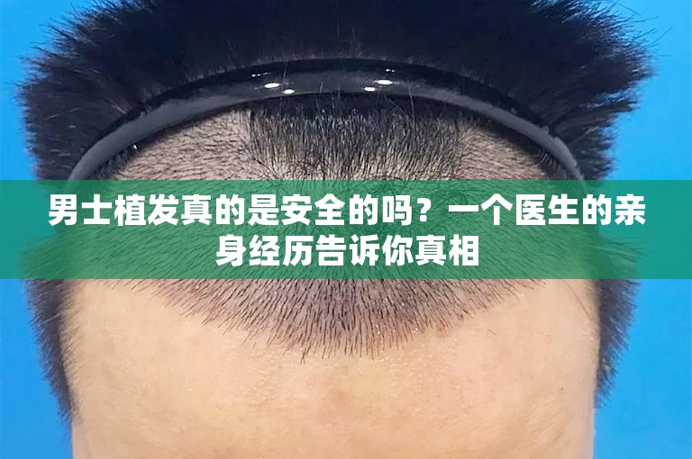 男士植发真的是安全的吗？一个医生的亲身经历告诉你真相