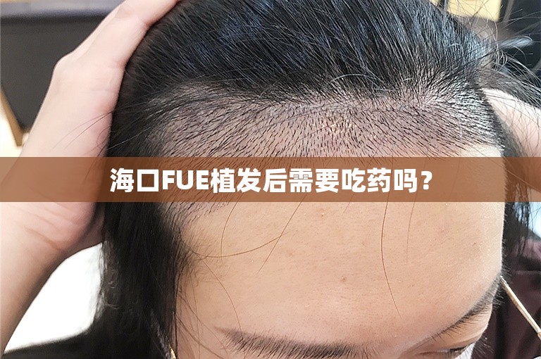 海口FUE植发后需要吃药吗？