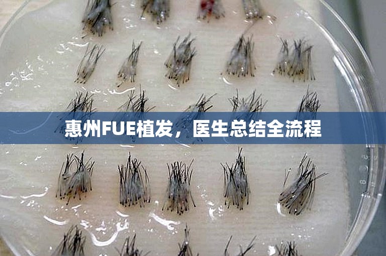 惠州FUE植发，医生总结全流程