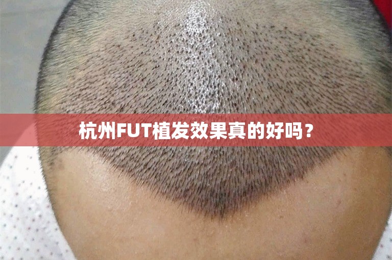 杭州FUT植发效果真的好吗？