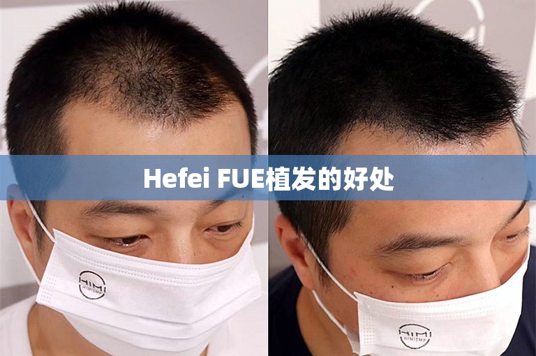 Hefei FUE植发的好处