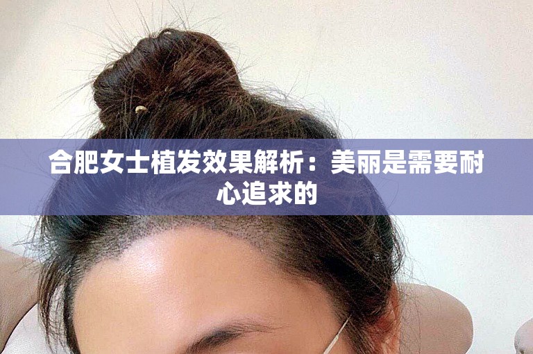 合肥女士植发效果解析：美丽是需要耐心追求的