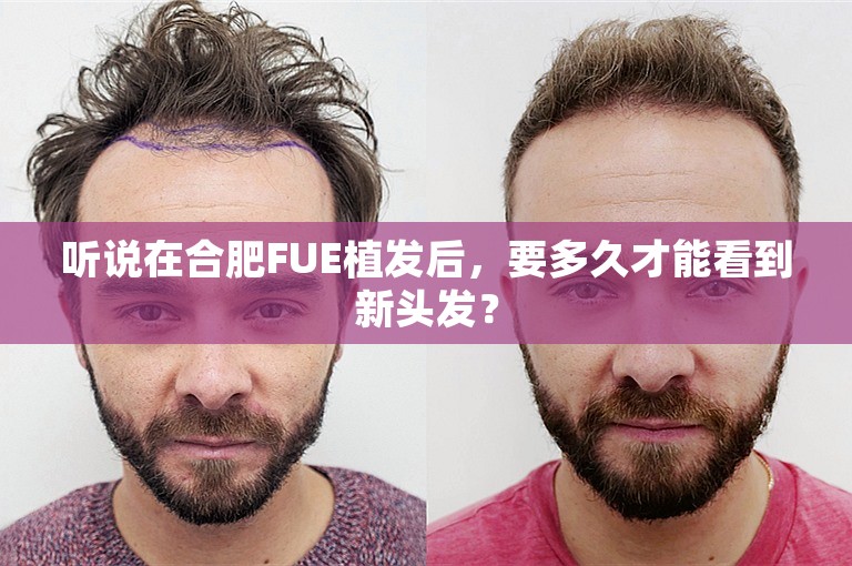 听说在合肥FUE植发后，要多久才能看到新头发？