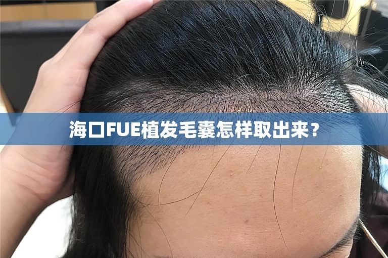 海口FUE植发毛囊怎样取出来？