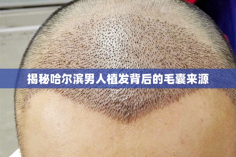 揭秘哈尔滨男人植发背后的毛囊来源