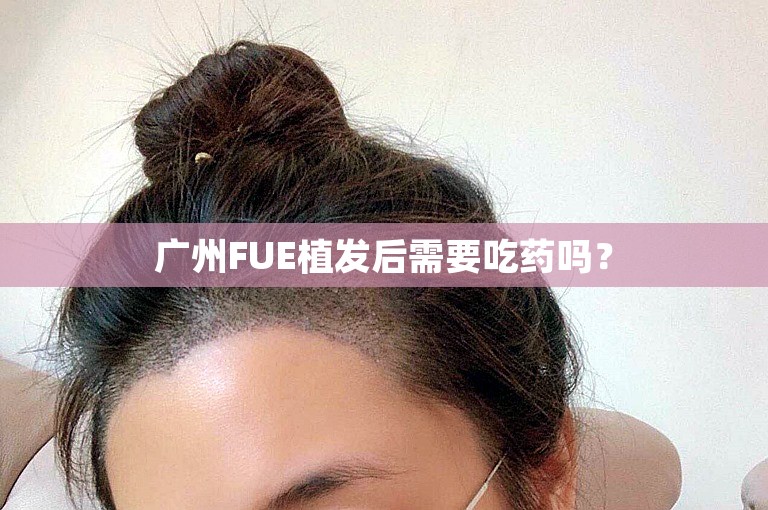 广州FUE植发后需要吃药吗？