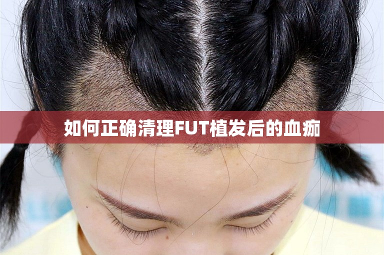 如何正确清理FUT植发后的血痂