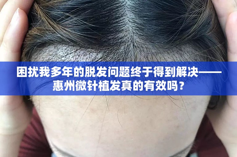 困扰我多年的脱发问题终于得到解决——惠州微针植发真的有效吗？