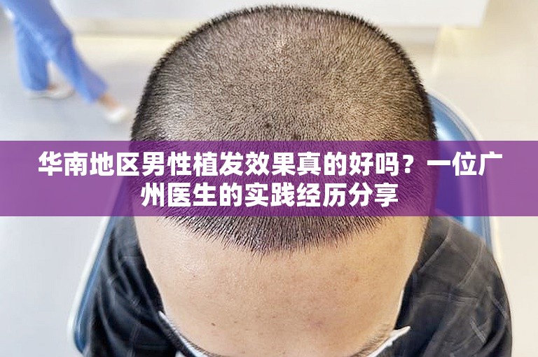 华南地区男性植发效果真的好吗？一位广州医生的实践经历分享