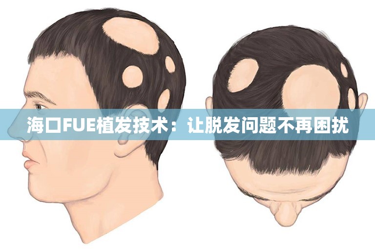 海口FUE植发技术：让脱发问题不再困扰