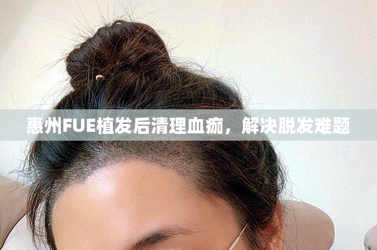 惠州FUE植发后清理血痂，解决脱发难题