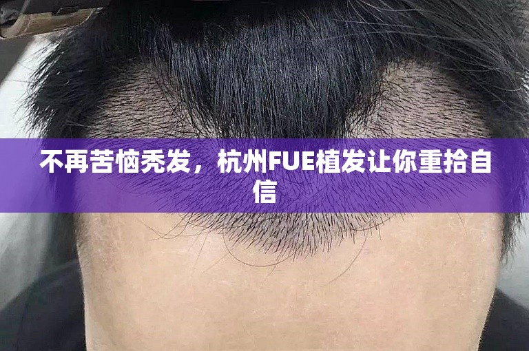 不再苦恼秃发，杭州FUE植发让你重拾自信