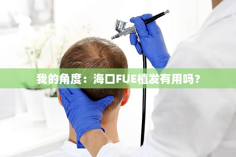 我的角度：海口FUE植发有用吗？