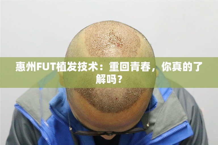 惠州FUT植发技术：重回青春，你真的了解吗？