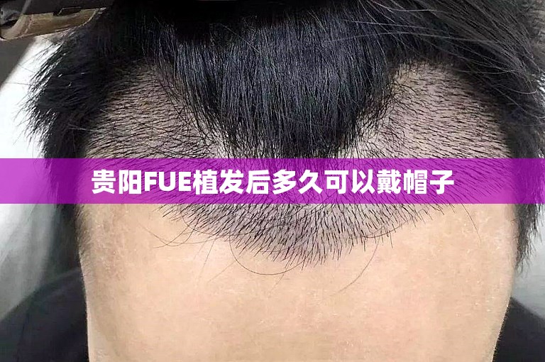 贵阳FUE植发后多久可以戴帽子