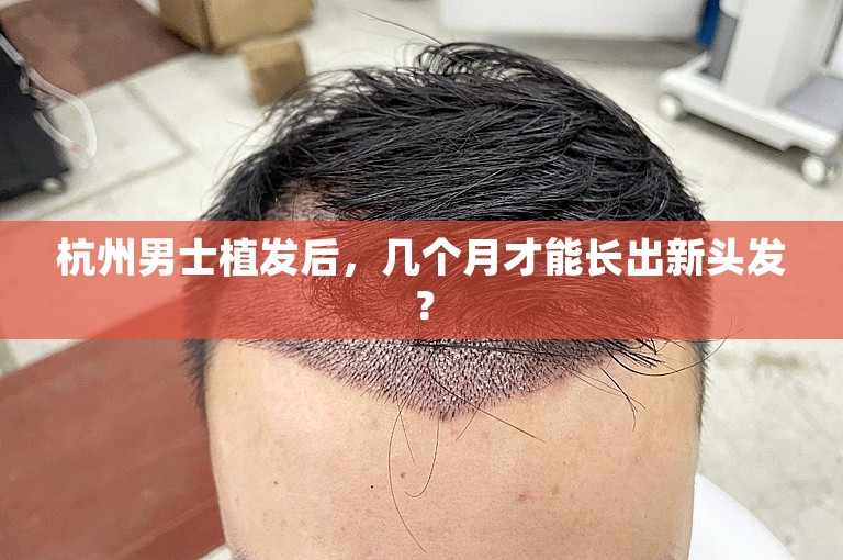 杭州男士植发后，几个月才能长出新头发？