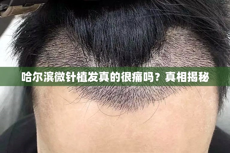 哈尔滨微针植发真的很痛吗？真相揭秘