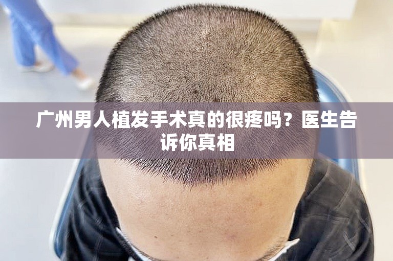 广州男人植发手术真的很疼吗？医生告诉你真相