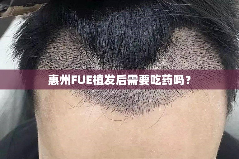 惠州FUE植发后需要吃药吗？