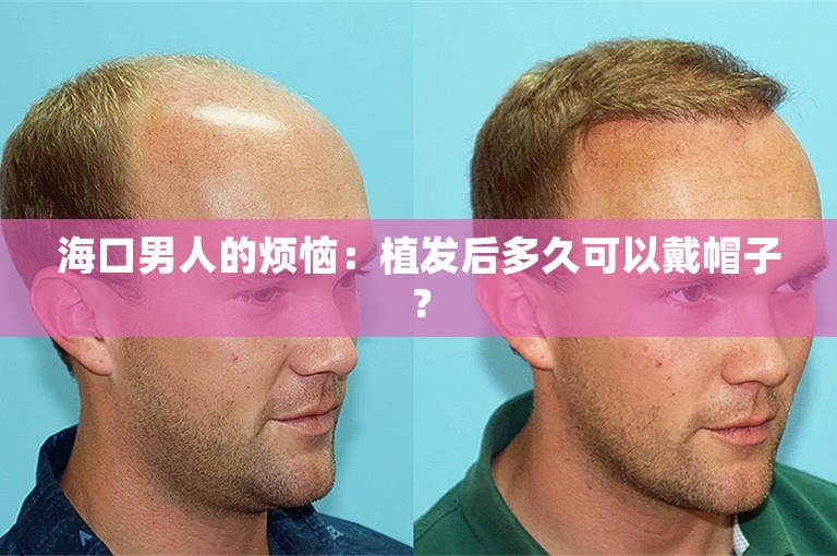 海口男人的烦恼：植发后多久可以戴帽子？