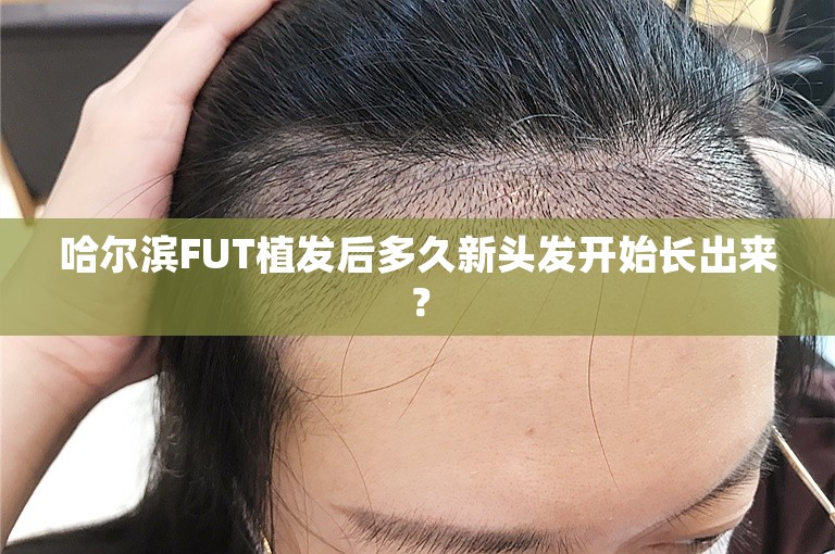 哈尔滨FUT植发后多久新头发开始长出来？