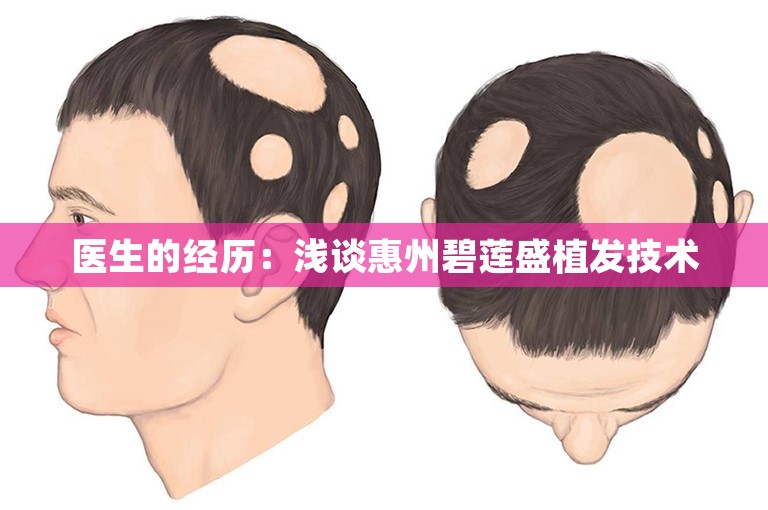 医生的经历：浅谈惠州碧莲盛植发技术