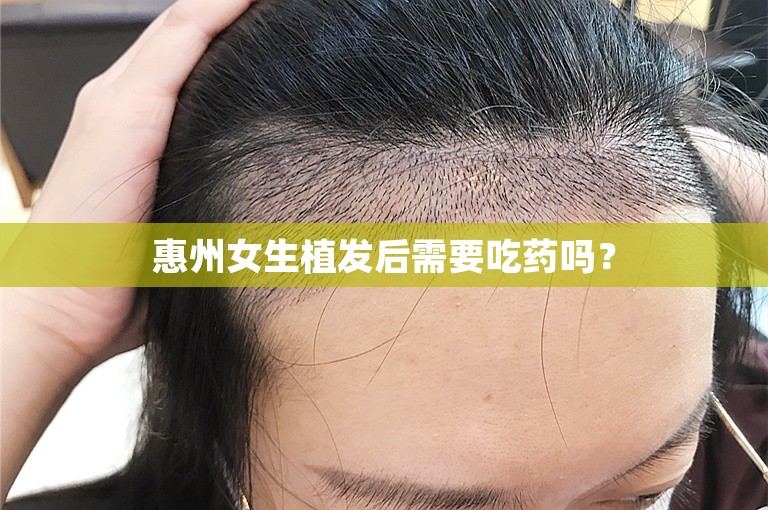 惠州女生植发后需要吃药吗？