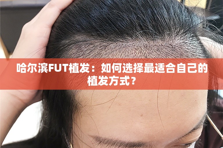 哈尔滨FUT植发：如何选择最适合自己的植发方式？