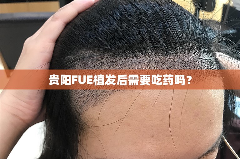 贵阳FUE植发后需要吃药吗？