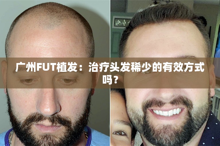 广州FUT植发：治疗头发稀少的有效方式吗？