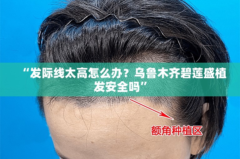 “发际线太高怎么办？乌鲁木齐碧莲盛植发安全吗”