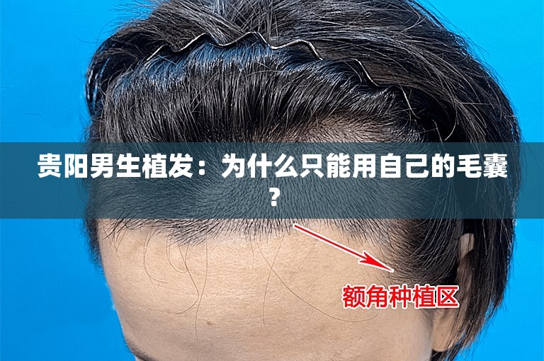 贵阳男生植发：为什么只能用自己的毛囊？