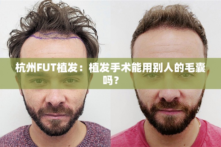 杭州FUT植发：植发手术能用别人的毛囊吗？