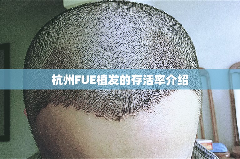 杭州FUE植发的存活率介绍