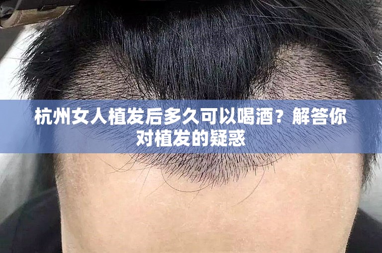 杭州女人植发后多久可以喝酒？解答你对植发的疑惑