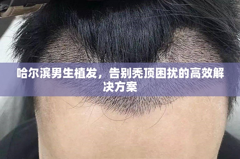 哈尔滨男生植发，告别秃顶困扰的高效解决方案