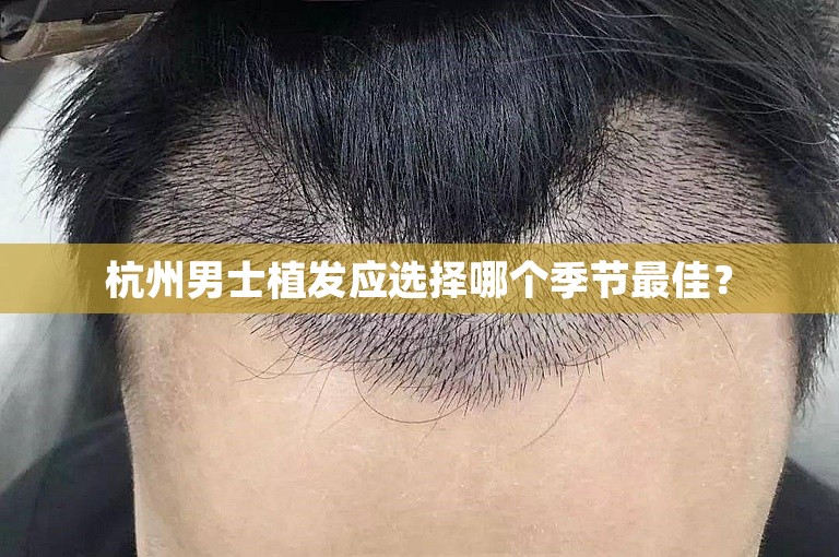 杭州男士植发应选择哪个季节最佳？