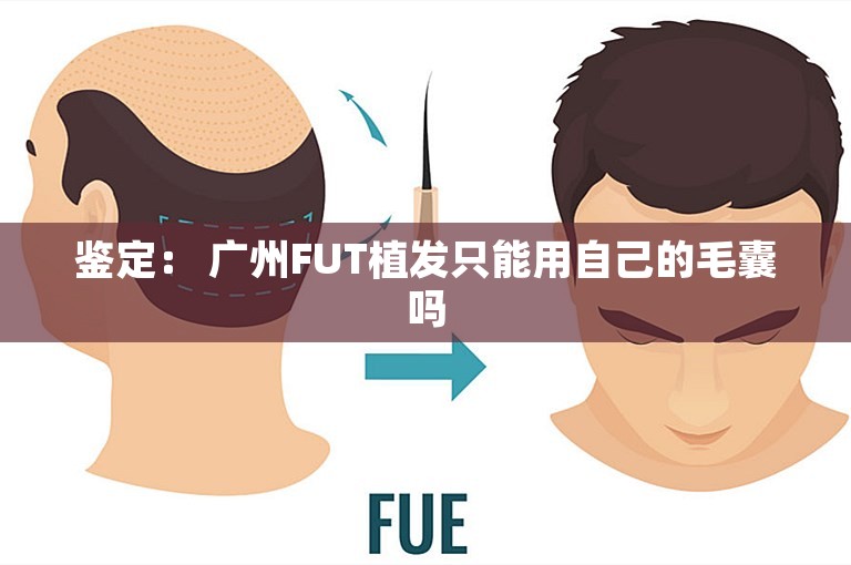 鉴定： 广州FUT植发只能用自己的毛囊吗