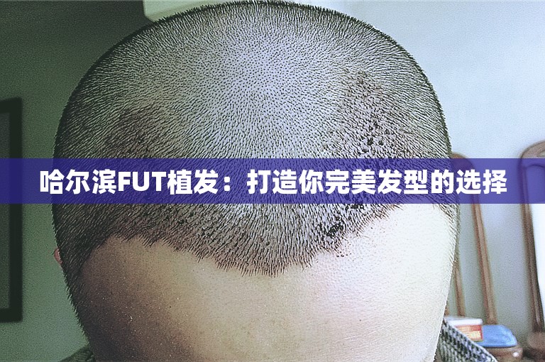 哈尔滨FUT植发：打造你完美发型的选择