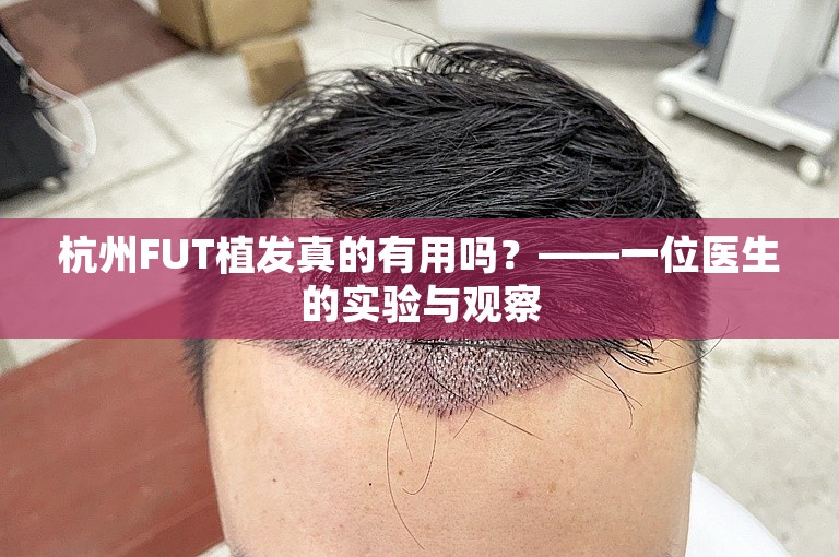 杭州FUT植发真的有用吗？——一位医生的实验与观察