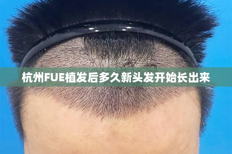 杭州FUE植发后多久新头发开始长出来