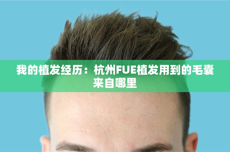 我的植发经历：杭州FUE植发用到的毛囊来自哪里