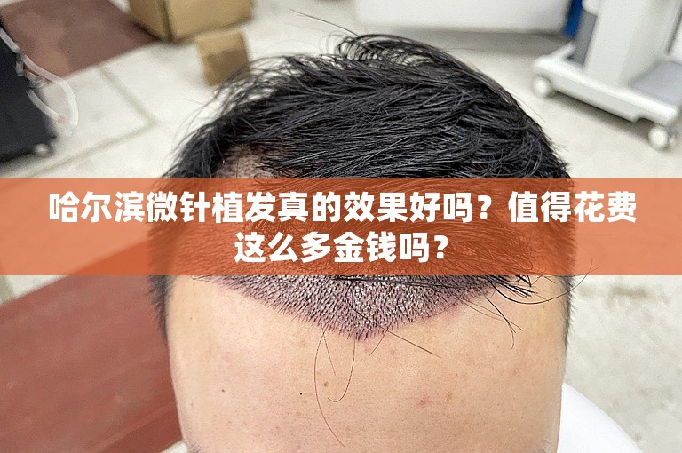 哈尔滨微针植发真的效果好吗？值得花费这么多金钱吗？