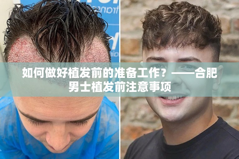 如何做好植发前的准备工作？——合肥男士植发前注意事项