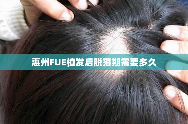 惠州FUE植发后脱落期需要多久