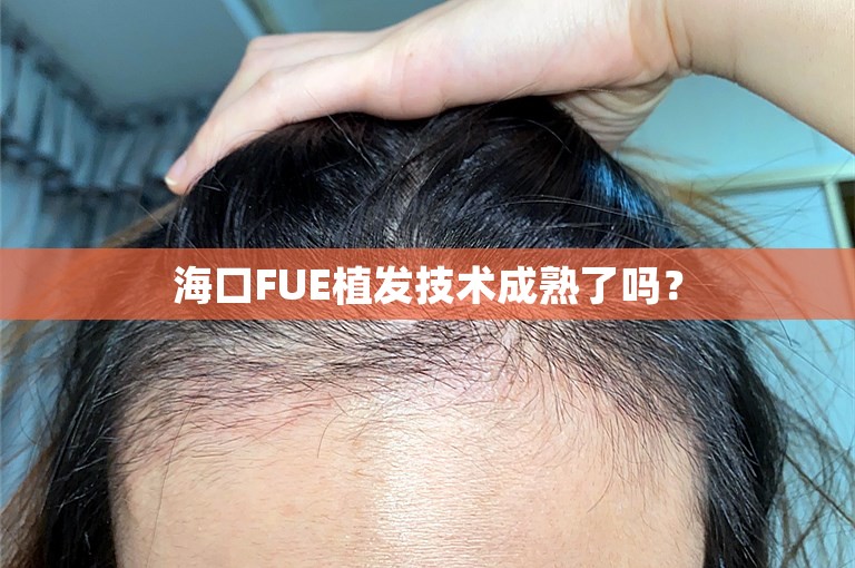 海口FUE植发技术成熟了吗？