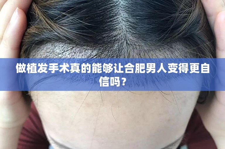 做植发手术真的能够让合肥男人变得更自信吗？