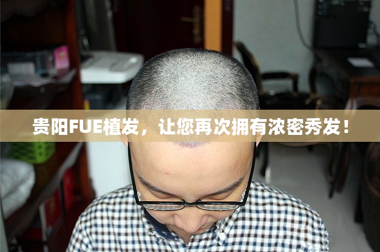 贵阳FUE植发，让您再次拥有浓密秀发！