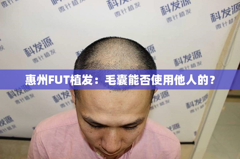 惠州FUT植发：毛囊能否使用他人的？